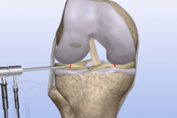 Articular Cartilage Problems – Drilling/Microfracture