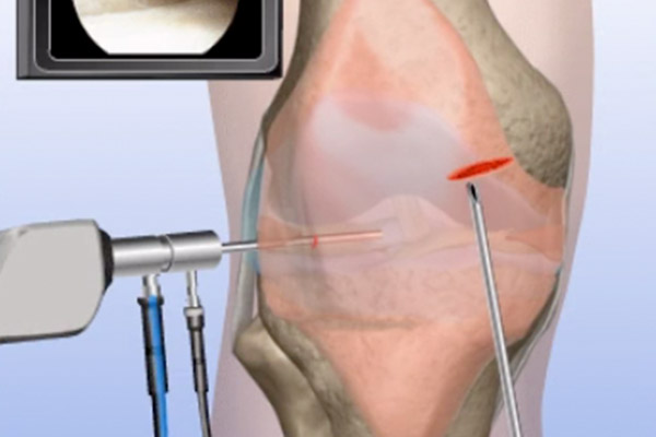 Patella Pain—Removal of Painful Plica