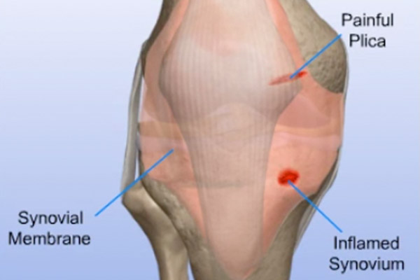 Synovial Problems—Removal of Inflamed Synovium